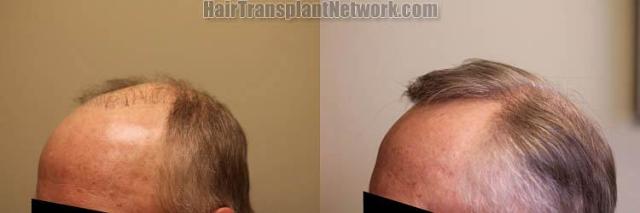 Hair transplantation surgery before and after pictures