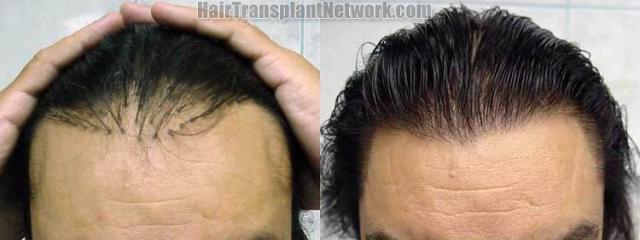 Hair restoration procedure results