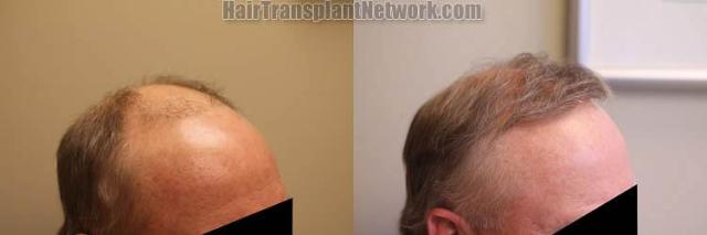 Hair transplantation surgery before and after photos