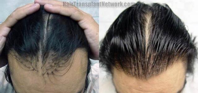 Hair restoration before and after repair pictures