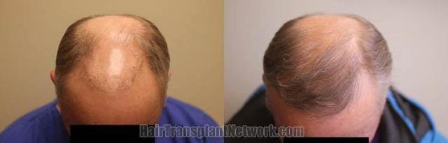 Hair transplantation surgery before and after photos