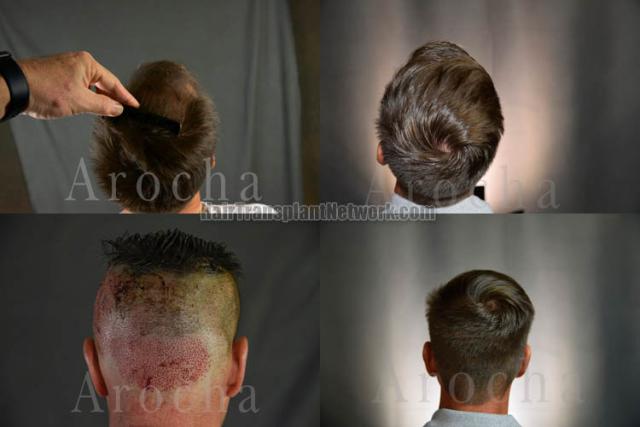 Hair replacement surgery before and after images