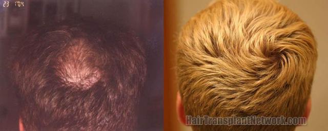 Top / crown view before and after hair transplant