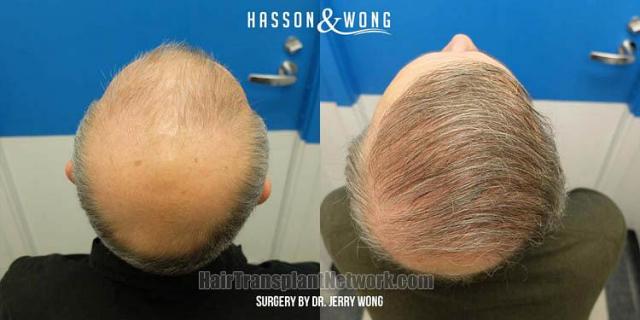 Hair restoration procedure before and after pictures