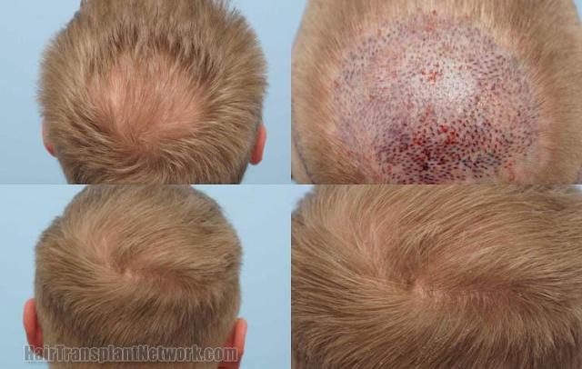 Hair transplantation surgery before and after photos