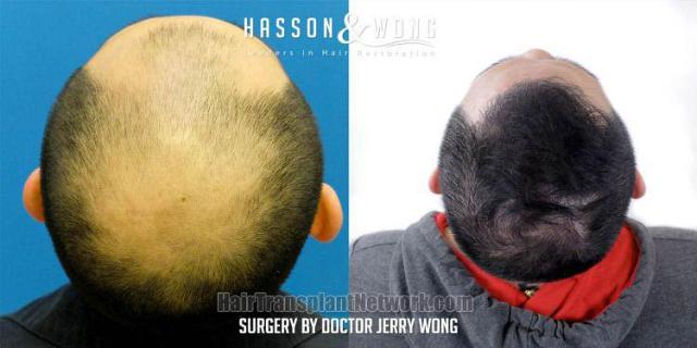 Hair replacement surgery before and after images