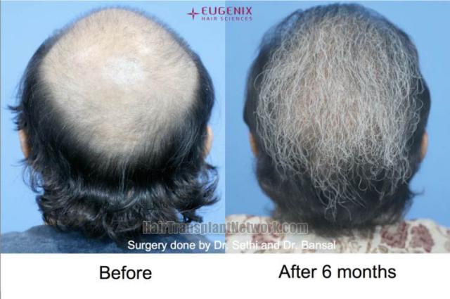 Surgical hair transplantation result photographs