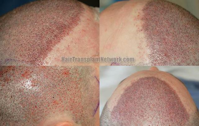 Hair replacement surgery before and after images