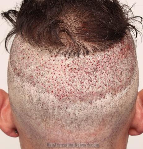 Surgical hair transplantation result photographs