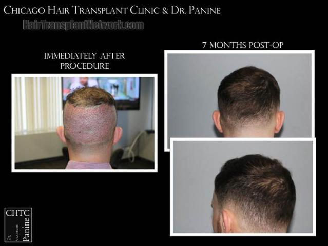 Hair replacement surgery before and after images