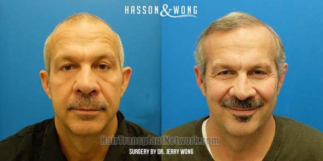 Hair restoration procedure before and after results