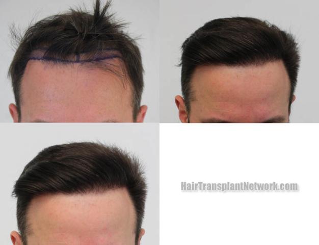 Before and after hair restoration procedure images