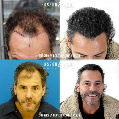 Front view - Before and after hair restoration procedure