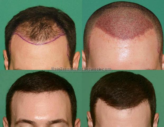 Front view - Before and after hair restoration procedure