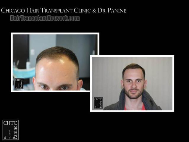 Front view - Before and after hair restoration procedure