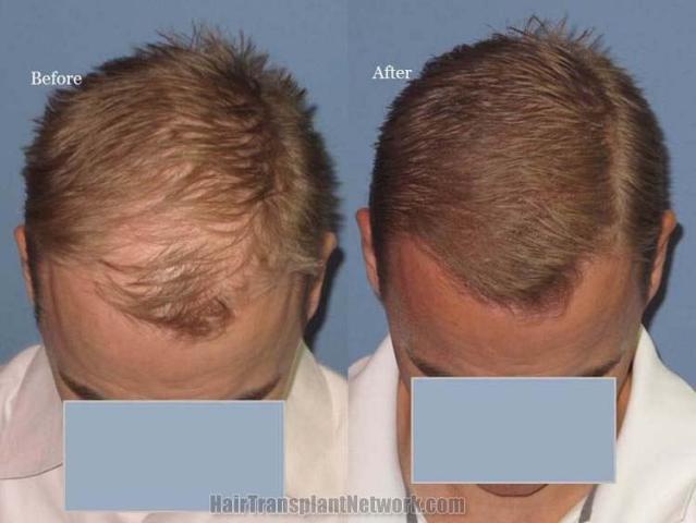 Top view before and after hair restoration results