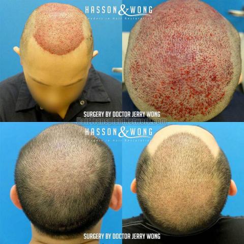 Hair restoration procedure before and after result images