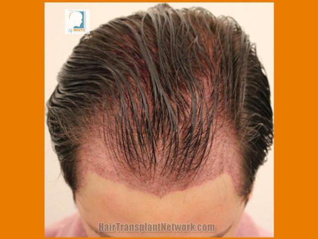 Hair restoration surgery before and after images