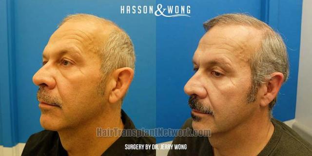 Hair transplantation surgery before and after pictures