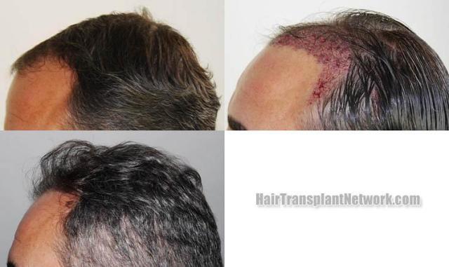 Hair restoration procedure before and after pictures