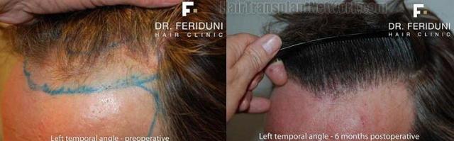 Hair transplant pictures showing left oblique angle results