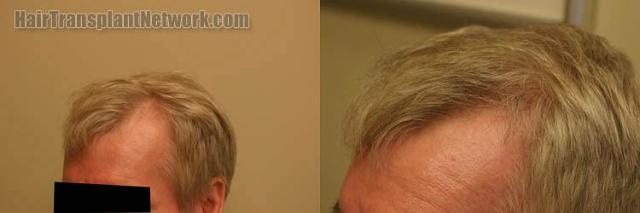 Left view before and after hair restoration procedure