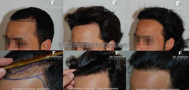 Before and after hair restoration procedure - Left views