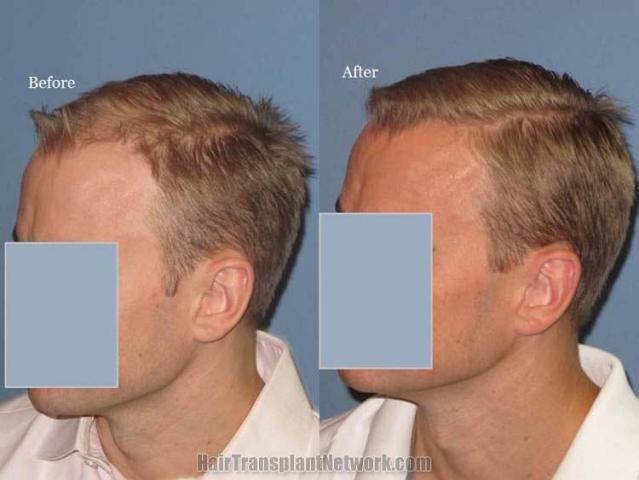 Hair transplantation surgery before and after photos