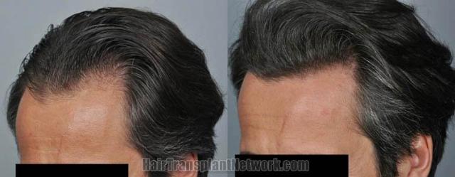 Hair transplantation surgery before and after images