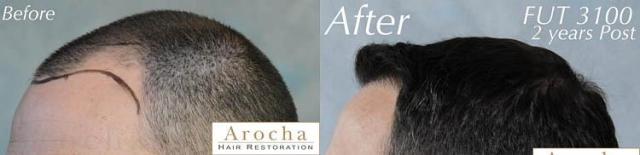 Hair transplantation surgery before and after pictures