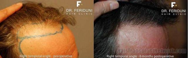 Hair restoration photos viewing right oblique angle results