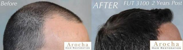 Hair transplantation surgery before and after images