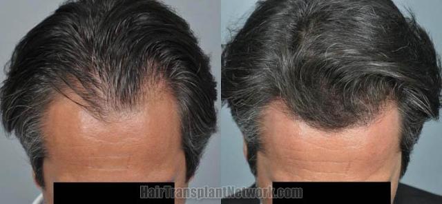 Top view before and after hair restoration results