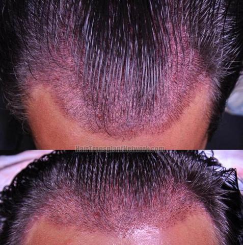 Hair transplantation surgery before and after pictures