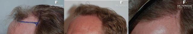 Hair restoration procedure before and after pictures