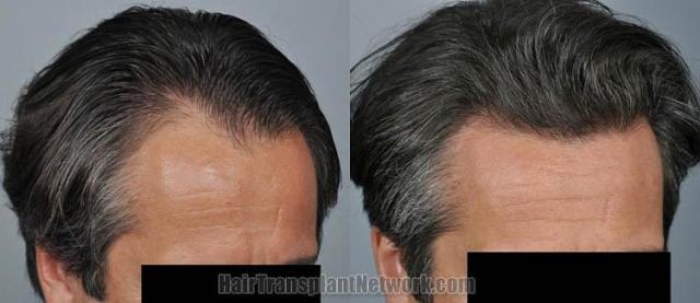 Hair transplantation surgery before and after photos