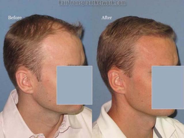 Hair restoration procedure before and after results