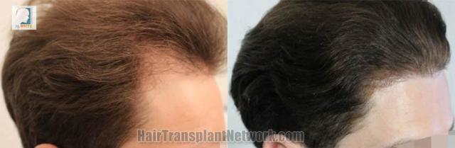 Hair transplantation surgery before and after images