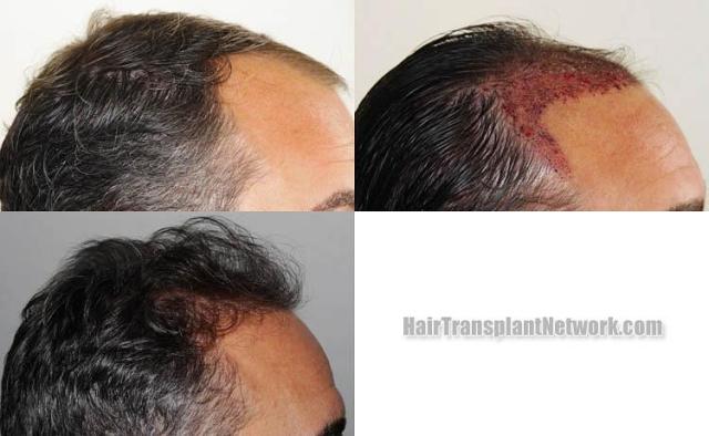 Hair transplantation surgery before and after images