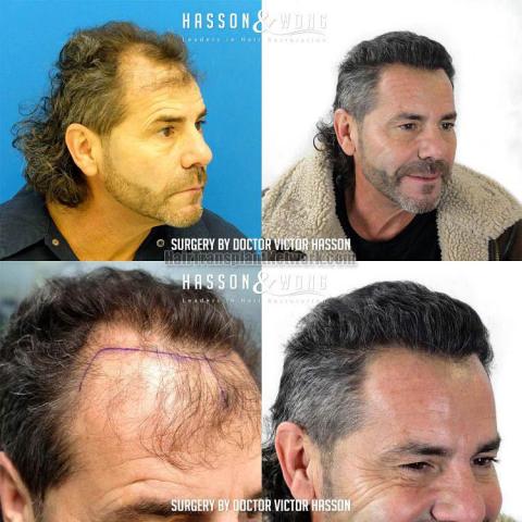 Hair transplantation procedure before and after results