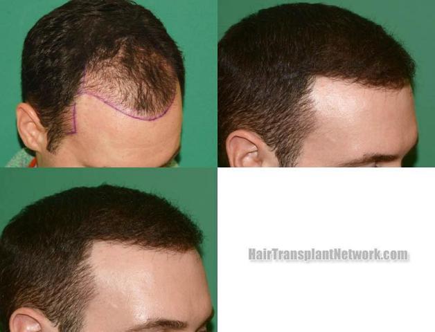 Hair restoration procedure before and after result images