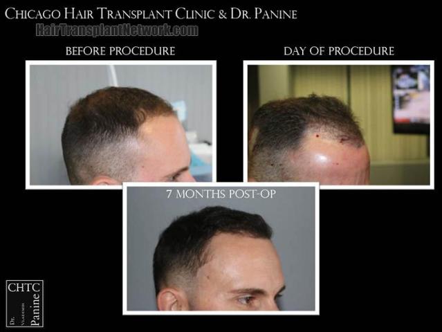 Hair transplantation procedure before and after results