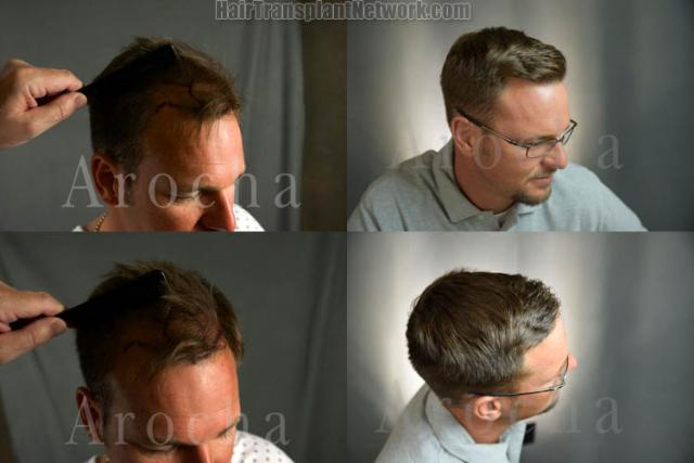 Hair transplantation procedure before and after results