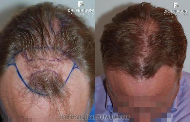 Top view before and after hair restoration