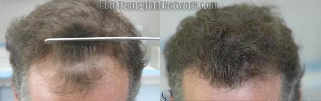 Hair restoration procedure before and after results