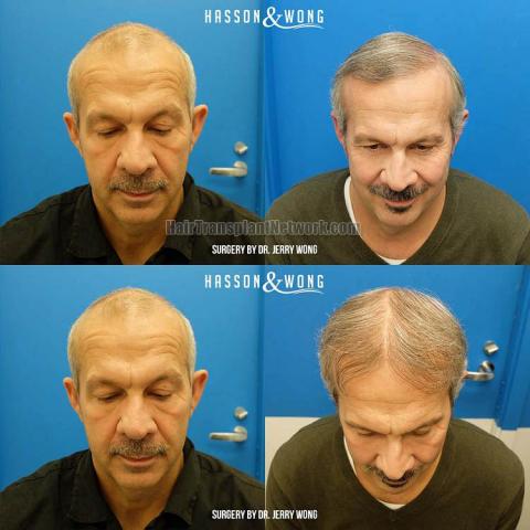 Hair transplantation surgery before and after photos