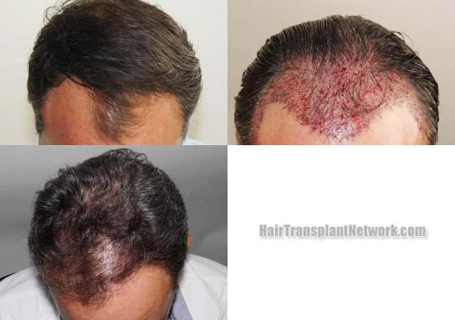 Hair restoration procedure before and after results