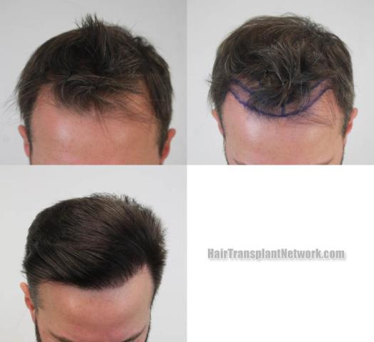 Top view - Before and after hair restoration procedure