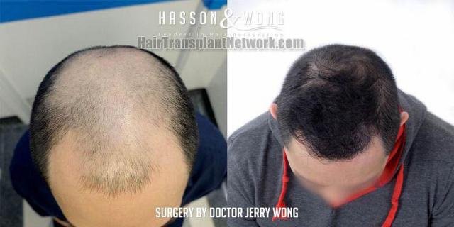 Top view - Before and after hair restoration procedure