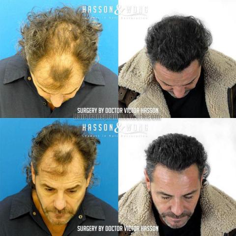 Hair transplantation surgery before and after images